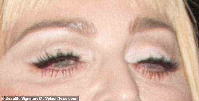 Neither Madonna's eyes or forehead show any signs of the kind of natural wrinkles you might expect with age, suggesting botox and an 'instant face lift' - also known as PDO Cog threads might have been administered