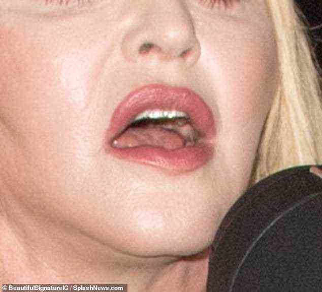 The Material Girl singer sports a full lip in her sixties, perhaps as the result of a 'gummy smile treatment' plus filler and botox