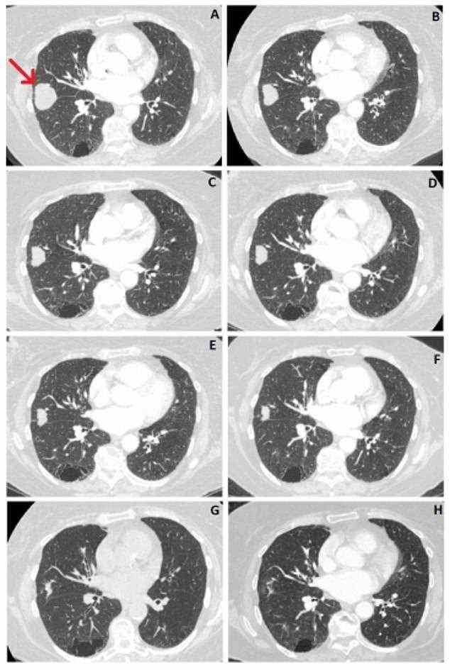 Die Scans zeigen den Tumor der Frau im mittleren Teil ihrer rechten Lunge (gekennzeichnet durch einen roten Pfeil), der in zweieinhalb Jahren um 76 Prozent geschrumpft ist.  Von links oben: Juni 2018, September 2018, November 2018, Februar 2019, Juni 2019, Oktober 2019, August 2020 und Februar 2021