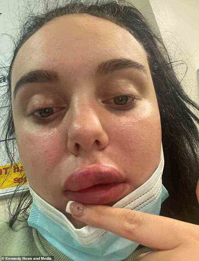 Amy behauptet, dass ihre geschwollene Lippe (im Bild) unter Sauerstoffmangel litt und sie 24 Stunden Zeit hatte, um ihr Gesicht zu retten, bevor das Gewebe vollständig starb, was dazu geführt hätte, dass sie eine Hauttransplantation benötigt hätte, um ihr Gesicht zu retten