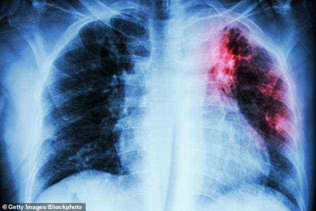 Zum ersten Mal seit 2005 stiegen die Todesfälle durch Tuberkulose im Jahr 2020 gegenüber dem Vorjahr auf 1,5 Millionen weltweit an, verglichen mit 1,4 Millionen im Jahr zuvor.  Beamte der WHO glauben, dass dies ein Zeichen dafür ist, dass jahrelange Fortschritte rückgängig gemacht werden.  Im Bild: Ein Röntgen-Thorax einer Person mit TB