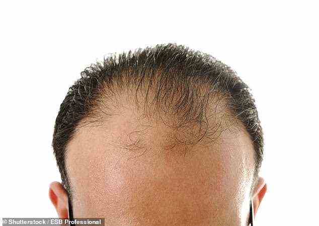 Dies klingt nach Alopecia areata, einer häufigen Erkrankung, bei der das Immunsystem versagt und Haarfollikel angreift.  Dies verursacht eine Entzündung, die den Haarproduktionsprozess schädigt