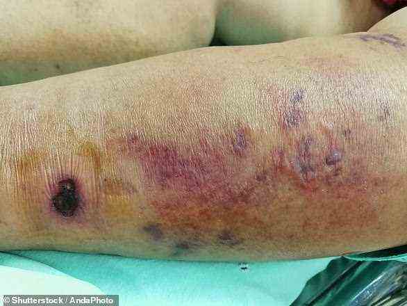 Das obige Foto zeigt ein Bein, das mit nekrotisierender Fasziitis infiziert ist