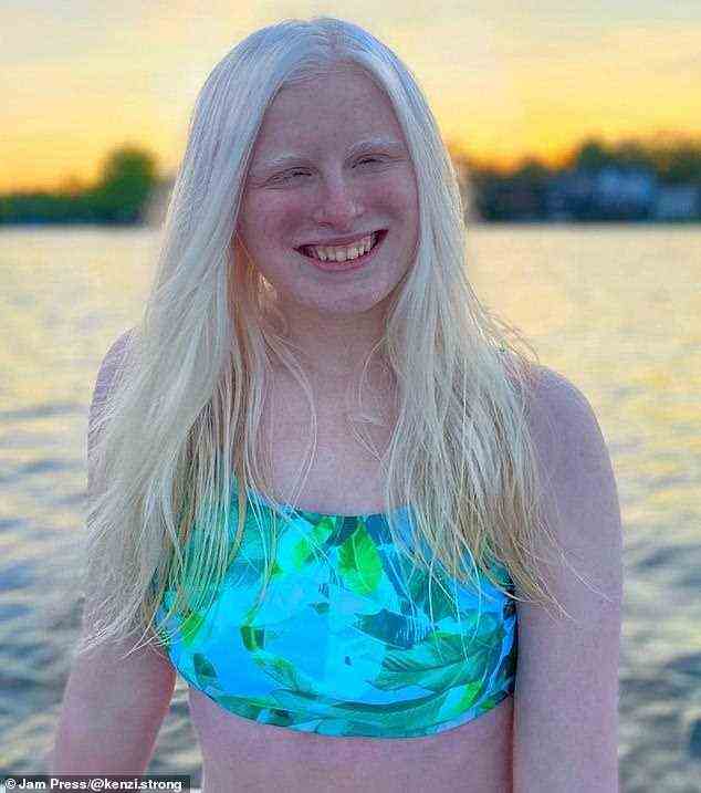 Albinismus von dem einer von 20.000 Menschen betroffen ist ¿ ist erblich, da beide Eltern von Mackenzie das Gen tragen, was ihnen eine 25-prozentige Chance gibt, ein Kind mit Albinismus zu bekommen