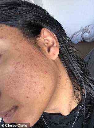 Eine andere Kundin nutzte die Behandlung sechs Wochen lang, um ihre von Akne geplagte Haut zu verwandeln und war von den beeindruckenden Ergebnissen begeistert (Bild).