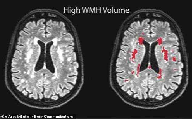 Forscher unter Leitung der Boston University fanden heraus, dass bei Magnetresonanztomographie (MRT)-Scans Hinweise auf Verletzungen der weißen Substanz des Gehirns gefunden werden können.  Diese Marker, die als „Hyperintensitäten der weißen Substanz“ bezeichnet werden, erscheinen als helle Flecken auf Gehirnscans.  Im Bild: Intensitäten der weißen Substanz, links und rot hervorgehoben rechts, wie in einem Scan aus einer früheren Studie zu sehen