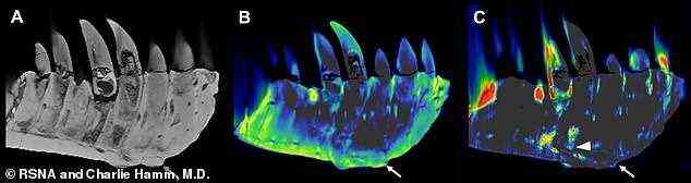 Die Bildgebung des Kiefers des T.Rex zeigte laut der Studie eine Verdickung und eine Masse auf seiner Oberfläche, die sich bis zur Zahnwurzel erstreckte.  Die Forscher entdeckten auch eine signifikante Menge des Elements Fluor in der Masse (im Bild), was ihrer Meinung nach ein Hinweis auf eine verringerte Knochendichte war und vermuteten, dass es durch eine Entzündung oder Schwellung im Kieferknochen verursacht wurde