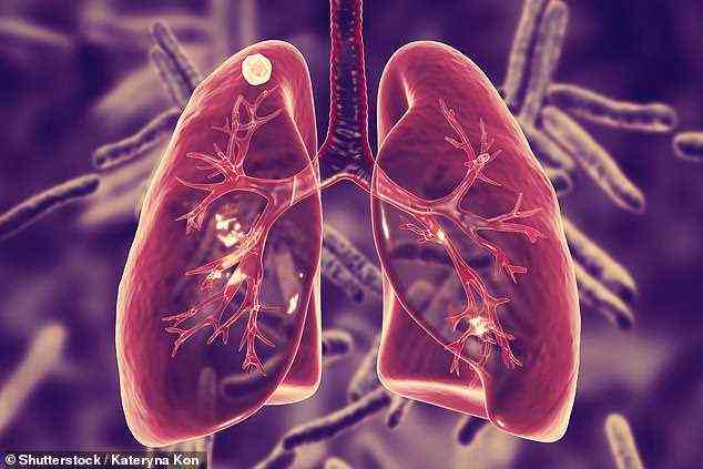 TB ist eine potenziell verheerende bakterielle Infektion, die dauerhafte Lungenschäden verursachen kann und sie einem weiteren Risiko durch ein Virus wie Covid aussetzt (Dateibild)