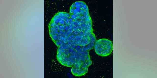 Dieses von den National Institutes of Health zur Verfügung gestellte Foto zeigt eine dreidimensionale Kultur menschlicher Brustkrebszellen, wobei DNA blau gefärbt und ein Protein in der Zelloberflächenmembran grün gefärbt ist.  (Nationale Gesundheitsinstitute über AP)
