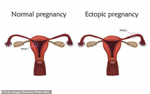 Bei einer typischen Eileiterschwangerschaft nistet sich ein befruchtetes Ei in den Eileiter ein, anstatt in die Gebärmutter zu wandern, wo es wachsen soll (Dateibild)