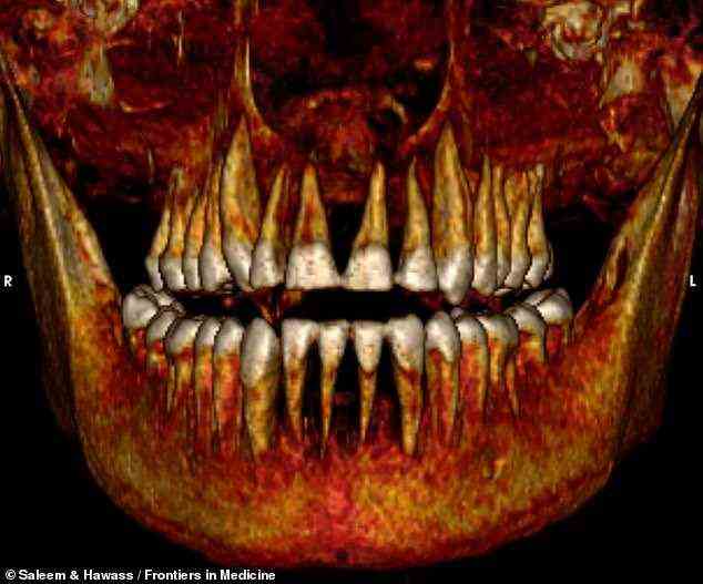 Amenhotep I was the second pharaoh of Egypt's 18th Dynasty and ruled from around 1525 to 1504 BCE. Pictured: CT scans revealed that his mummy had a full set of healthy teeth