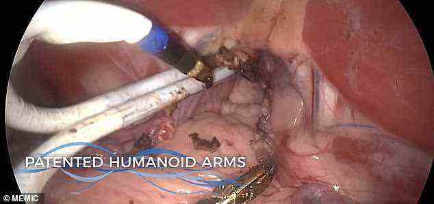 Ein zusätzlicher Arm führt eine laparoskopische Videokamera durch einen kleinen, separaten Schnitt, um den internen Eingriff zu visualisieren
