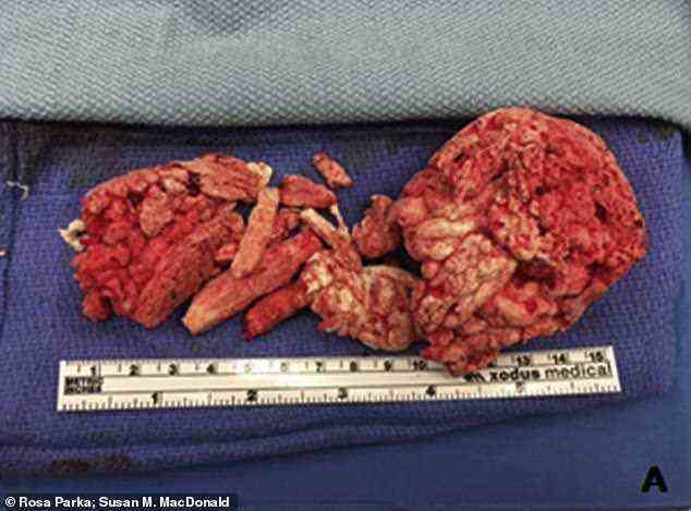 Pictured here is the total amount of insulation foam removed from the man's bladder and penis after it was unintentionally sprayed inside him. Some of the pieces measured up to 10cm in length and up to 4.3cm in width