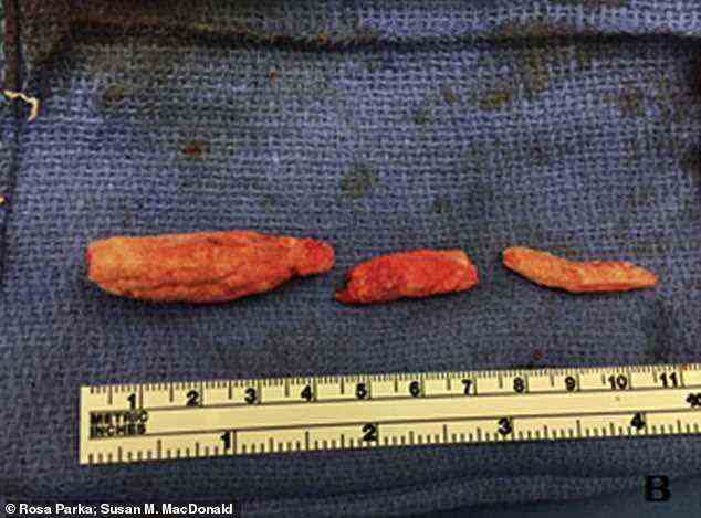 The pieces of foam that became trapped inside the man's penis. These pieces proved too hard to remove by pulling them out of the penis so instead doctors opted to remove them by cutting a hole in the man's perineum, the area between the scrotum and the anus. Some of these pieces were  up to 16mm in length
