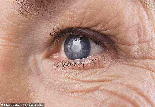 Katarakte sind trübe Flecken auf der Augenlinse, die normalerweise als Folge des Alterns entstehen.  Sie werden normalerweise mit der Zeit schlimmer und eine Operation ist die einzige Möglichkeit für die Betroffenen, ihre Sehkraft zu verbessern (Bestand)