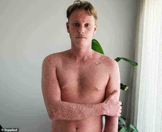 Jorden Hendey aus dem Norden von New South Wales (im Bild) leidet unter topischem Steroidentzug (TSW) infolge des übermäßigen Gebrauchs von Steroidcremes seit 20 Jahren zur Linderung seines Ekzems, wodurch seine Haut unglaublich schuppig wird