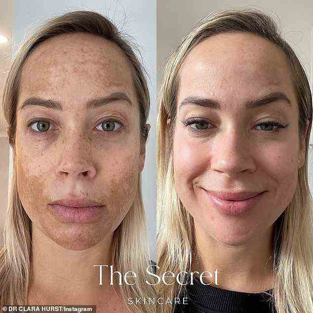 Karli Moyler, die an der Gold Coast lebt, verwendete die verschreibungspflichtige Hautpflegemarke The Secret, um einige der dunklen Flecken und Melasma zu lindern, die sich während ihrer letzten Schwangerschaft verschlimmerten