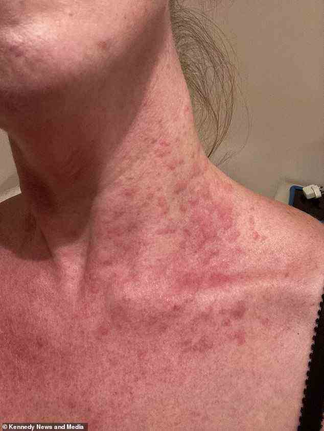 After being prescribed steroids by the doctor, she suffered a further allergic reaction to the tablets and broke out in rashes all over her body
