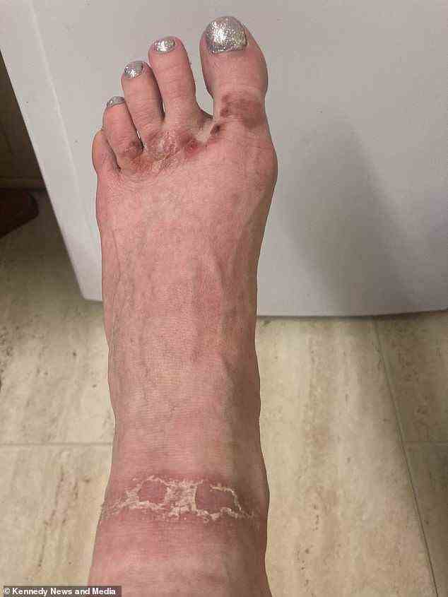 Her feet are now taking weeks longer to heal - and have been scabbing and painfully peeling in the process (pictured)