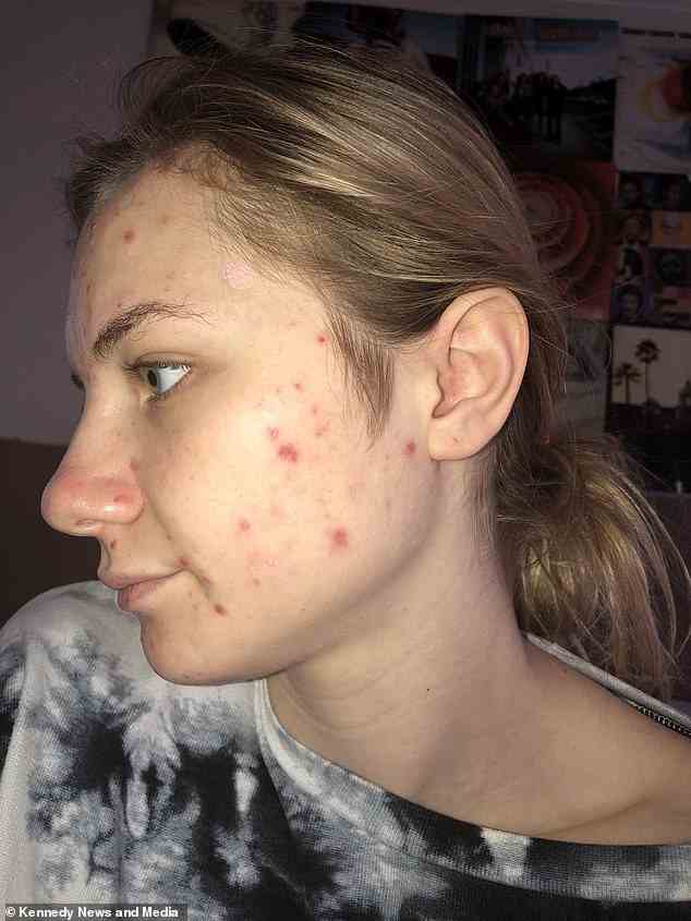 Even when Aubrey would wear makeup, she found that the texture of her skin made it hard to hide her condition