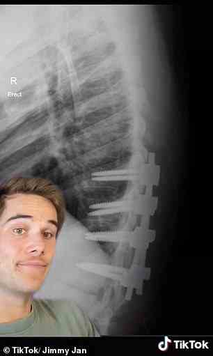 Die Ärzte sagten Jimmy während der Operation, sie hätten sein Rückenmark dekomprimiert und die Frakturen mit Schrauben und Stäben stabilisiert