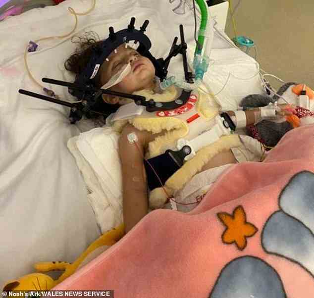 Alice wurde ein Luftröhrenschnitt verabreicht und die Ärzte erklärten, dass die Wahrscheinlichkeit, dass ein Kind in ihrem Alter die Verletzungen überlebt, so gering sei, dass sie Schwierigkeiten hatten, eine Halo-Traktion zu finden – ein Gerät zur Verlängerung der Wirbelsäule (im Bild) – klein genug für sie