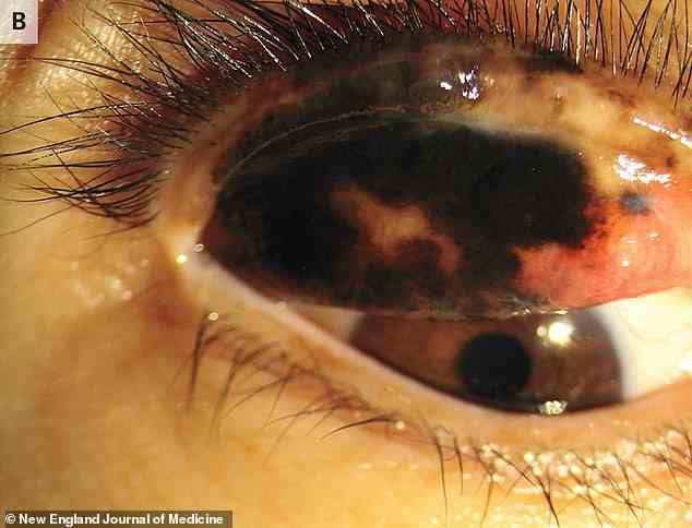Nach einer Augenlidumstülpung fanden die Ärzte eine bösartige Läsion auf ihrem Auge