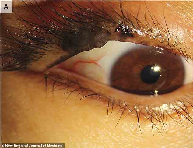 Als die 47-jährige Frau zu einem Arzt ging, fanden sie etwas, das unter ihren Augenlidern hervorragte, was den Ärzten den ersten Hinweis gab, dass etwas direkt über ihrem rechten Auge nicht stimmte.