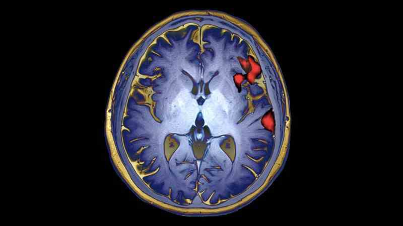 Farbige funktionelle Magnetresonanztomographie (MRIf)-Scan der Gehirnaktivität bei der Sprachproduktion.