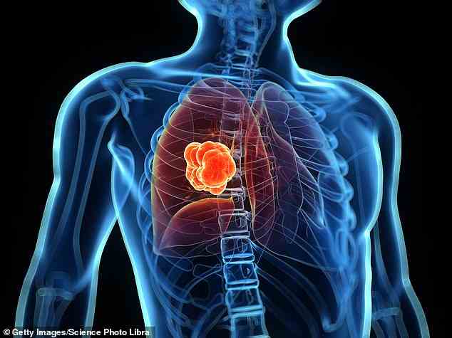 Tausende weitere NHS-Patienten mit einer tödlichen Art von Lungenkrebs sollen von einem Medikament profitieren, das als größter Durchbruch bei der Behandlung seit Jahrzehnten gefeiert wird (Archivbild)