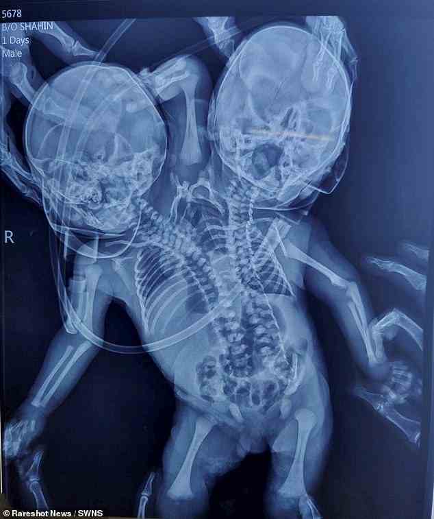 Der Zustand ist als dizephaler Parapagus bekannt – bei dem zwei Säuglinge durch einen Oberkörper verbunden sind – und führt häufig zu einer Totgeburt.  (Im Bild: Röntgenaufnahme von Siamesischen Zwillingen)
