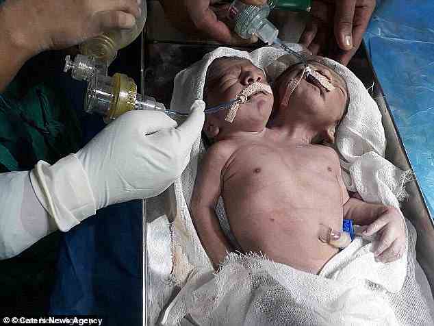 Zwei Jungen, die 2017 ebenfalls in Indien mit dieser Krankheit (im Bild) geboren wurden, starben nur 24 Stunden nach der Geburt