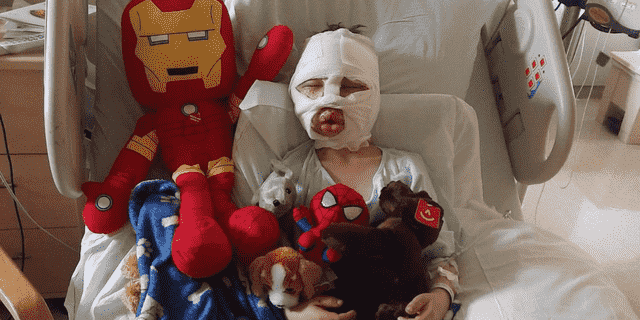 Dominick Krankall, 6, hat ein geschwollenes Gesicht und eine lange Genesung, könnte aber als Folge des Vorfalls eventuell minimale Narben haben.