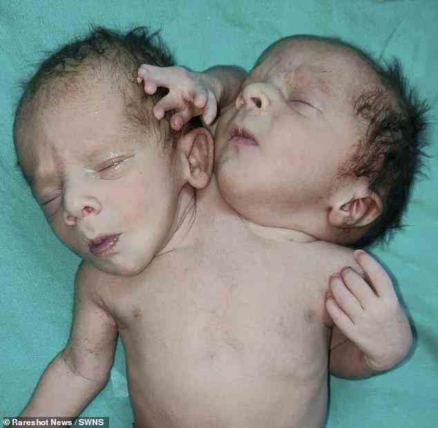 Die siamesischen Geschwister (im Bild), geboren am 28. März in Ratlam im indischen Bundesstaat Madhya Pradesh, haben ebenfalls drei Arme und zwei Herzen
