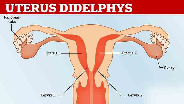 Uterus didelphys ist eine seltene Erkrankung, bei der eine Frau mit zwei Gebärmutter geboren wird.  Diese können ihren eigenen Gebärmutterhals haben oder selten – wie bei Stephanie – auch Vaginas