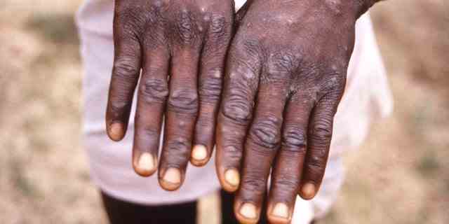 Ein Bild aus einer Untersuchung eines Ausbruchs von Affenpocken in der Demokratischen Republik Kongo (DRK) von 1996 bis 1997 zeigt die Hände eines Patienten mit einem Ausschlag aufgrund von Affenpocken, in diesem undatierten Bild, das Reuters am 18. Mai 2022 erhalten hat. 