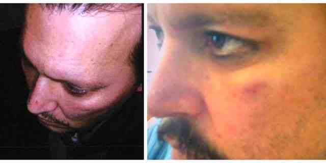Beweisfotos, die Verletzungen zeigen, die Johnny Depp erlitt, nachdem Ex-Frau Amber Heard ihm im März 2015 angeblich ins Gesicht geschlagen hatte. 