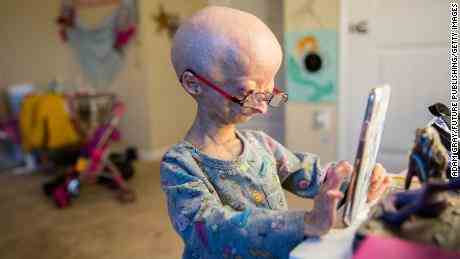 Eine 11-jährige Adalia spielt 2017 in ihrem Zimmer mit ihrem Telefon. Neben vorzeitigem Altern sind weitere Symptome der Progerie Zwergwuchs, Körperfett- und Muskelmangel, Haarausfall, sichtbare Venen, eine hohe Stimme, und Steifheit in den Gelenken. 