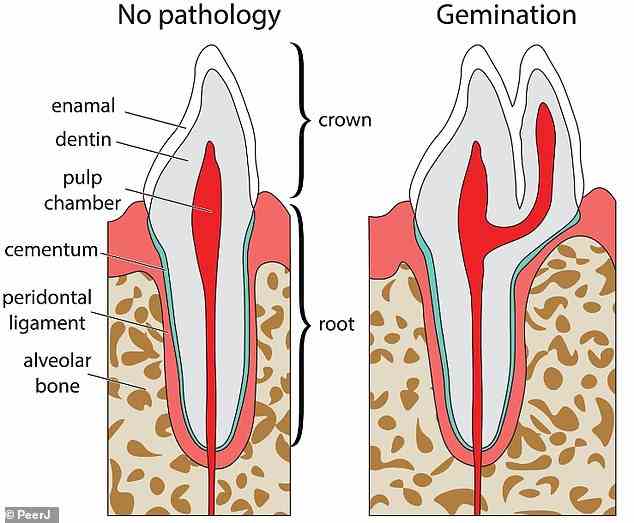 Während der Zahnentwicklung können zwei Zahnknospen zu einer verschmelzen oder eine Zahnknospe kann sich in zwei Teile teilen (ein Prozess, der als Gemination bezeichnet wird, rechts).