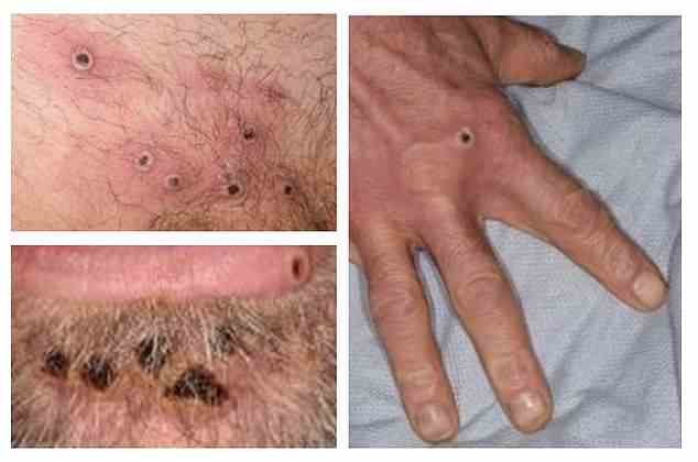The infection often starts with small bumps that scab over and are contagious