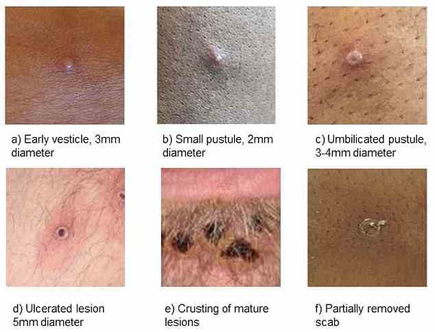 Officials are urging gay and bisexual men to be aware of new lesions, rashes or scabs and get in contact with a sexual health clinic. They have released these images of cases to alert people to the virus' symptoms