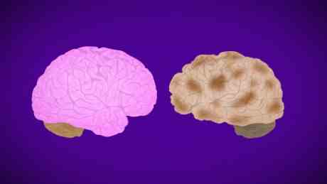 Schnelle Fakten zur Alzheimer-Krankheit
