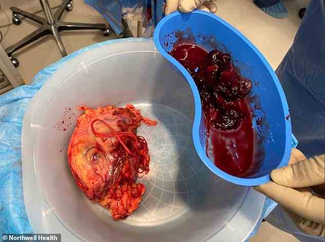 Oben abgebildet sind der Nierentumor und die rechte Niere, die die Ärzte während des Eingriffs entfernt haben (im weißen Eimer).  Die „schlangenartigen“ Wucherungen durch Arterien sind in der blauen Schale dargestellt