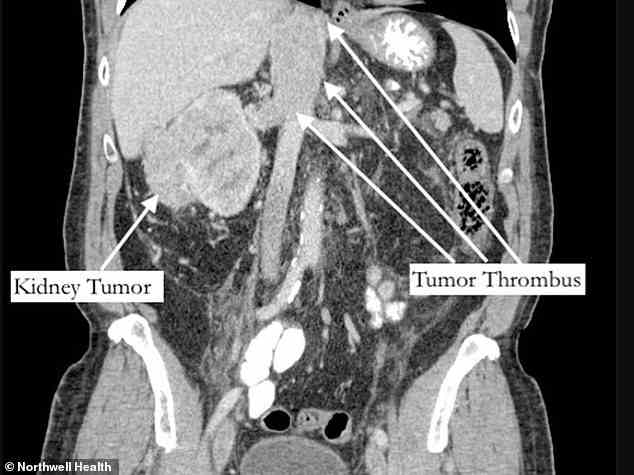 Dies ist ein Scan von Bernstein.  Es zeigt den Nierentumor auf seiner rechten Seite, wobei auch der fußlange Tumorthrombus in den Venen zu sehen ist