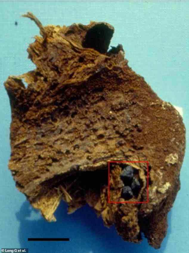 Leber und Gallenblase von Giovani d'Avalos.  Im roten Rechteck sind die Gallensteine ​​zu sehen, die Fragmente von E. Coli enthalten.  Der Maßstabsbalken entspricht 1 cm