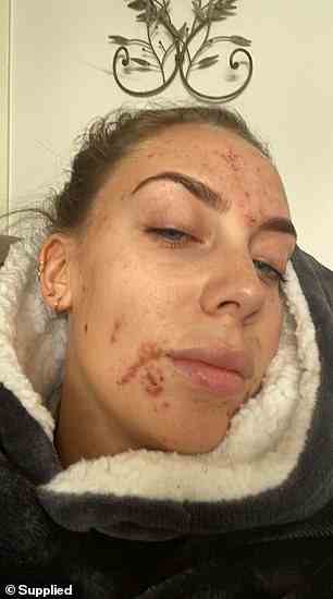Vorher: Louisa Josem aus Melbourne beschloss, die Antibabypille im Januar 2021 abzusetzen, aber drei Monate später war ihr Gesicht mit hormonell bedingter Akne bedeckt (Bild