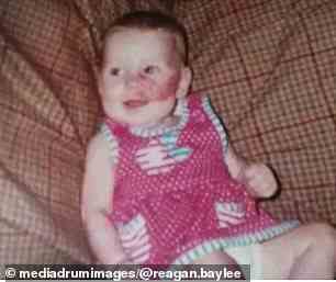 Although the 25-year-old(pictured as a baby) was born with the stain, she still struggled with confidence