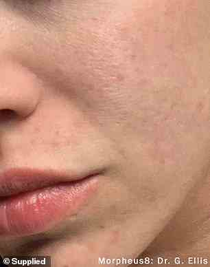 Abgebildet die Hautbehandlung bei Akne