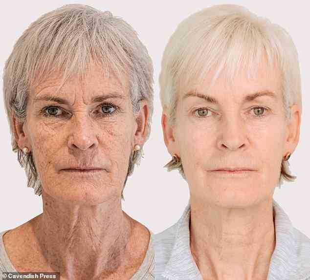 Judy Murray, 61, hat sich seit Januar 2020 in Glasgow drei Micro-Needling- und Radiofrequenzbehandlungsterminen unterzogen, um „über 10 Jahre jünger auszusehen“ (vorher links und jetzt rechts abgebildet).