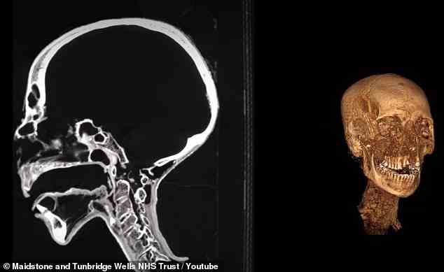 Ein CT-Scanner wurde an dem decapeptidierten Mumienkopf verwendet, der es dem Team ermöglichte, ihn in 3D nachzubilden und zu analysieren, was sich möglicherweise unter der Verpackung verbirgt